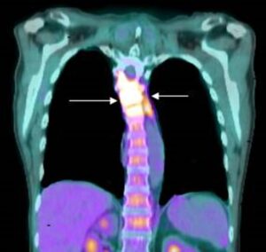 If Cancer Spreads to the Bones