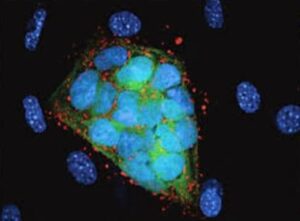 Neuroendocrine Cancer Biomarkers